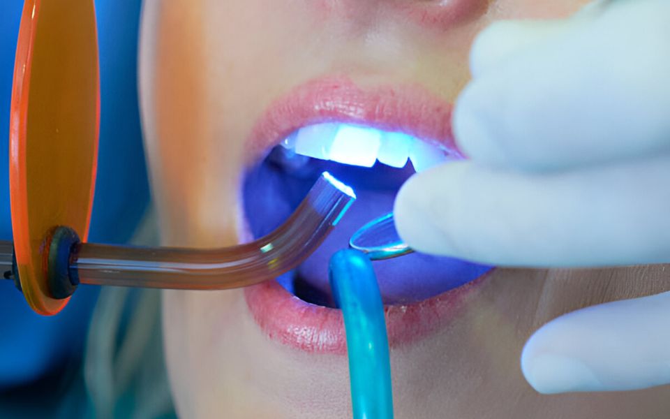Transform Your Smile Instantly with Seamless Direct Bonding