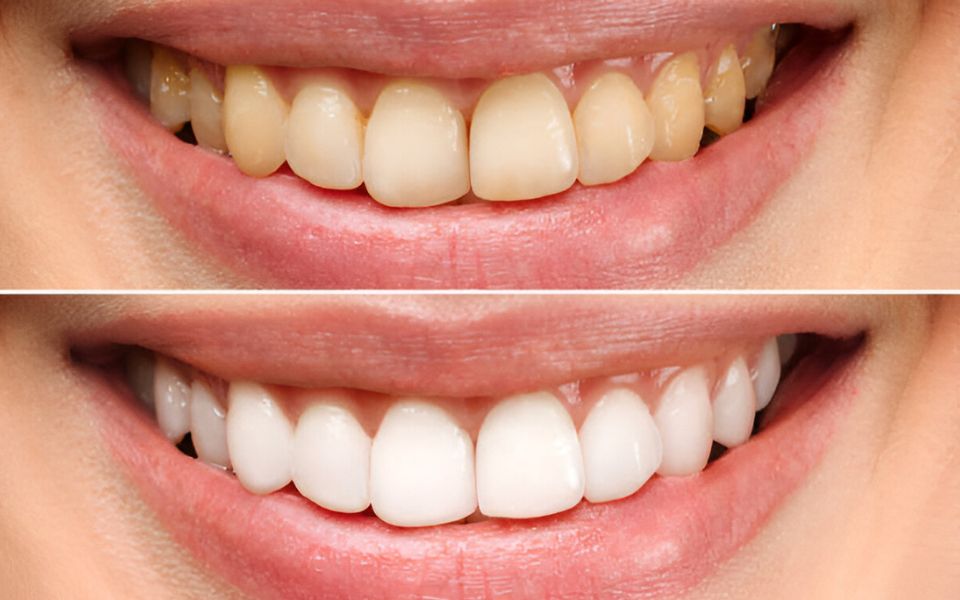 Is Professional Teeth Whitening the Secret to Your Brightest Smile?