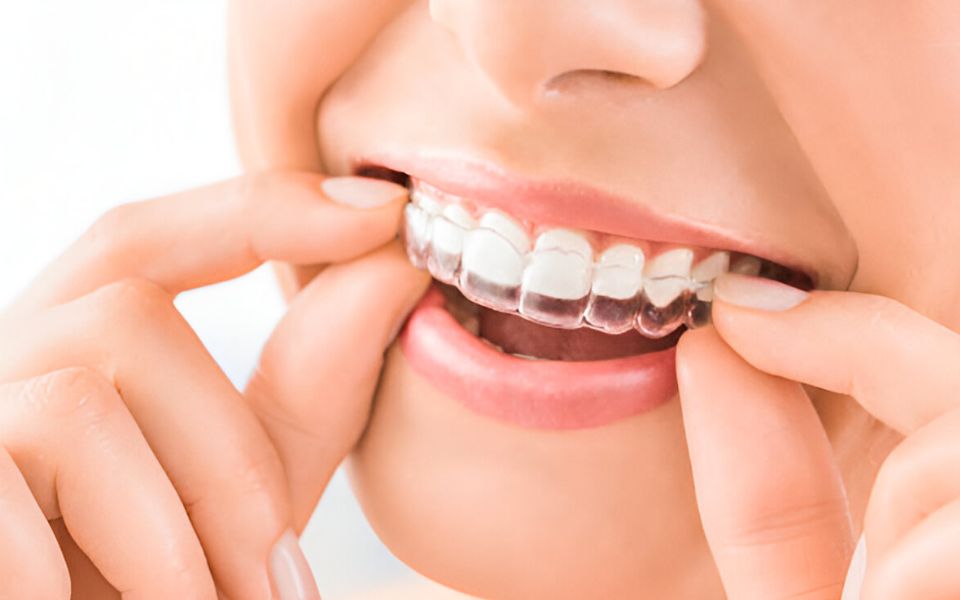 Transparent Braces in Hyderabad: The Future of Orthodontics