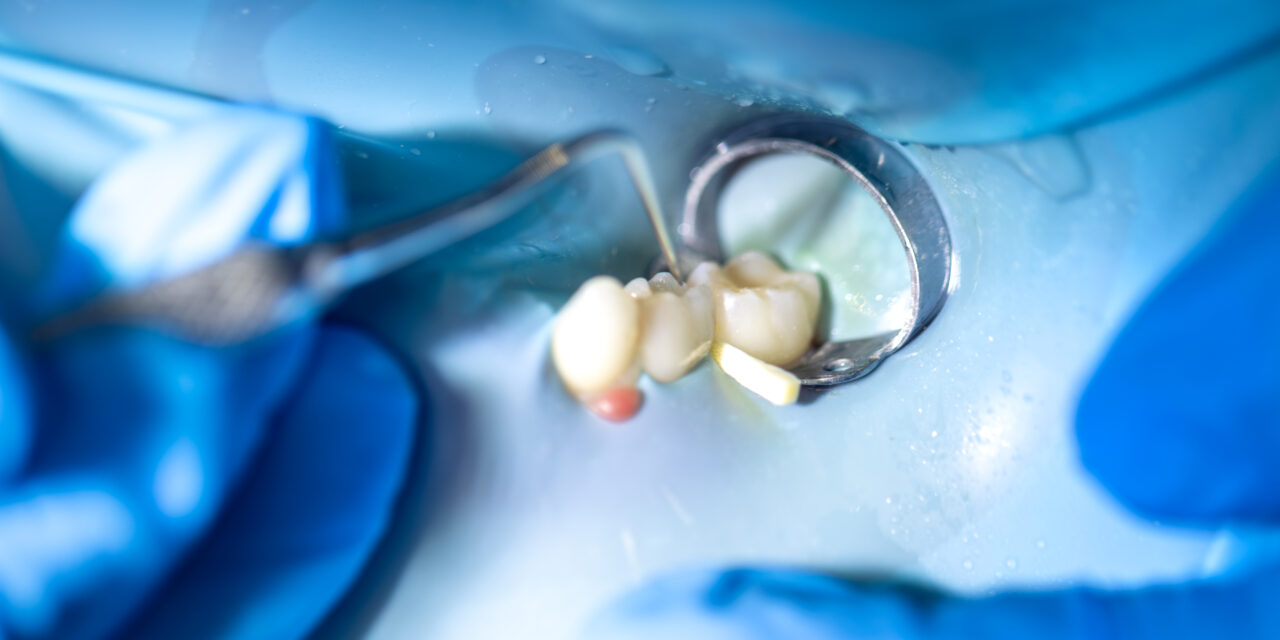 Wisdom Tooth Removal: 5 Things You’ll Wish You Knew Earlier