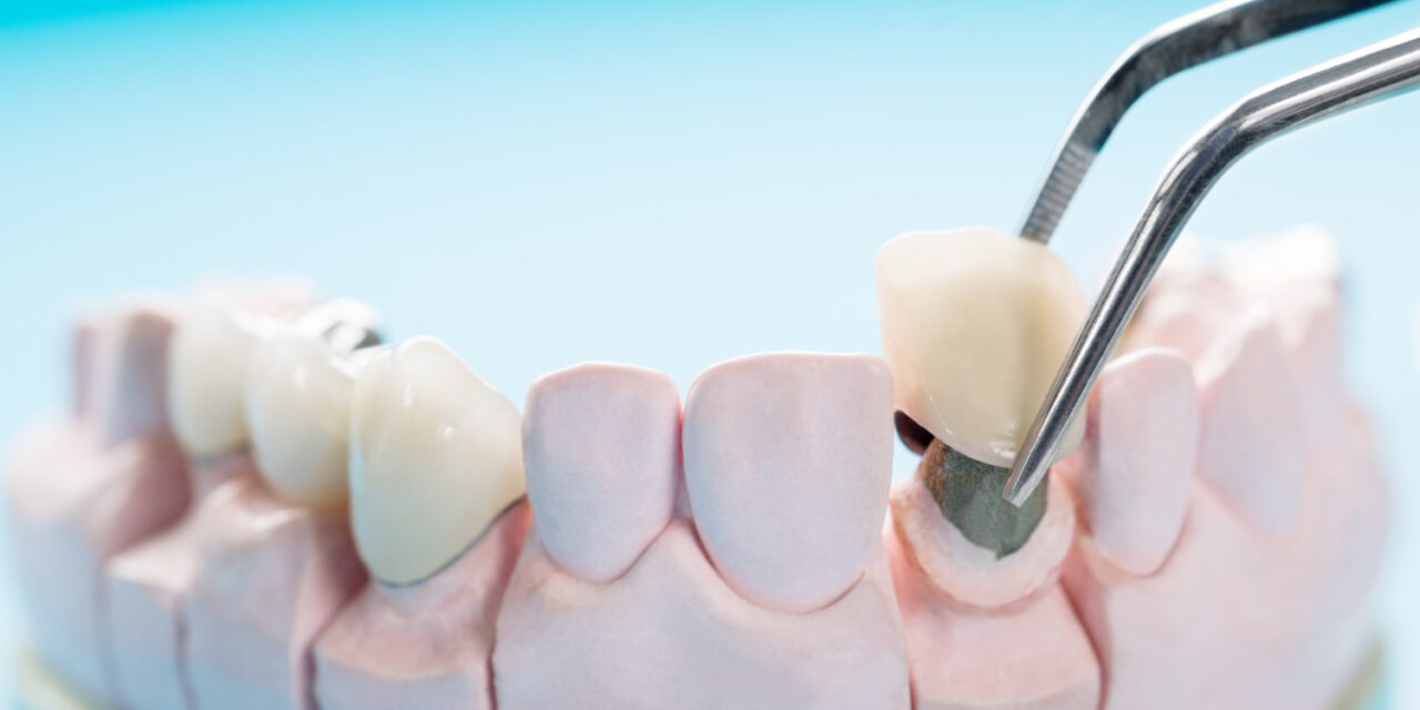 Dental Crown Types and Costs in India: A Complete Guide for Patients
