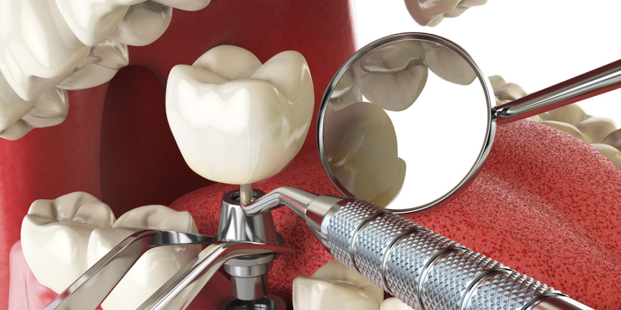 Dental Implant Procedure Explained: 5 Key Phases You Should Know