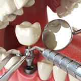 Dental Implant Procedure