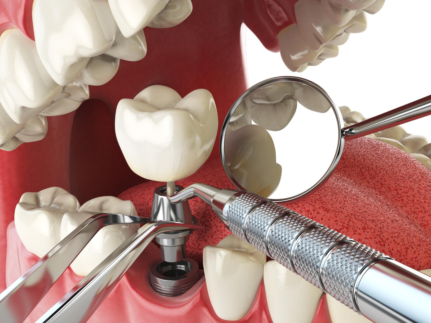 Dental Implant Procedure Dental Implant Procedure