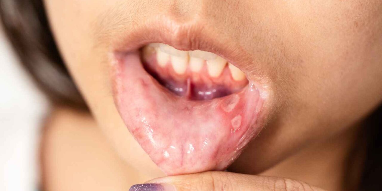 Mouth Infections: Warning Signs, Causes, and Treatments You Should Never Ignore