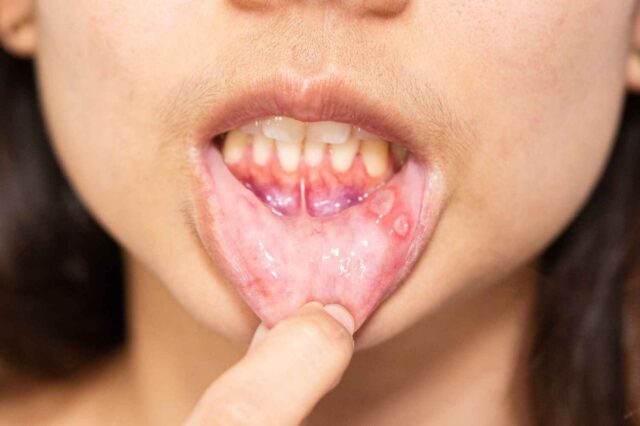 Mouth Infections