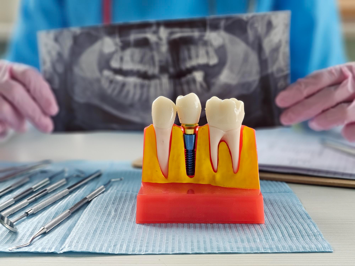 Dental Implant Procedure Dental Implant Procedure