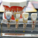 Zirconia Dental Crown