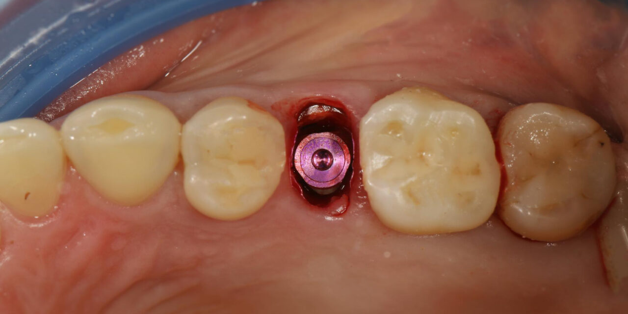 Cavity Fillings Made Simple: Types, Benefits, and Cost in Hyderabad