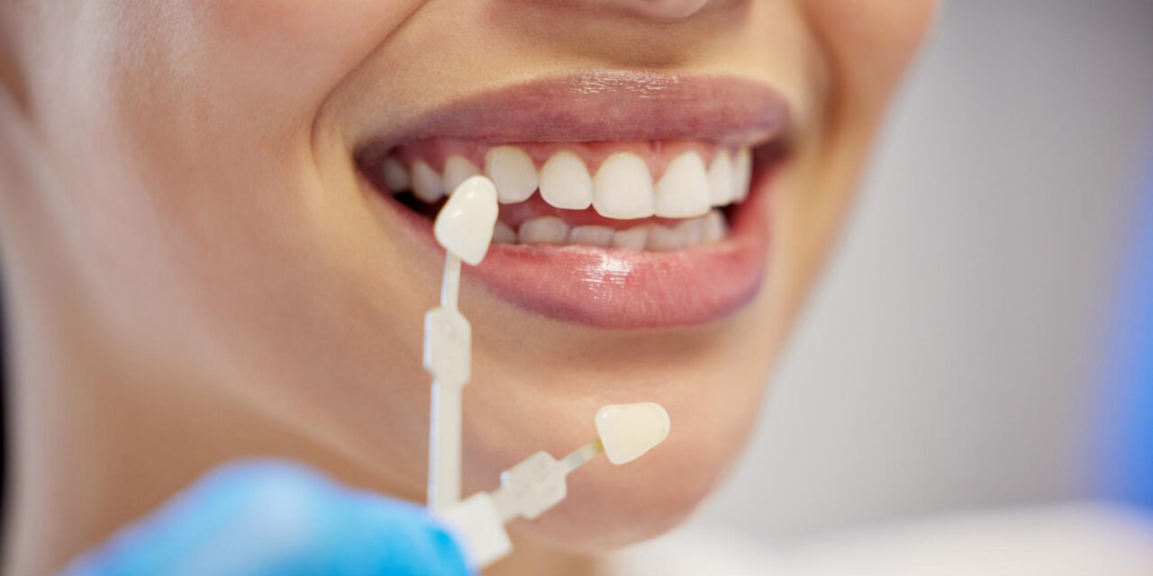 Dental Veneers: Types, Procedure, Benefits, and Cost in Hyderabad