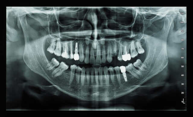 OPG Dental X-Ray