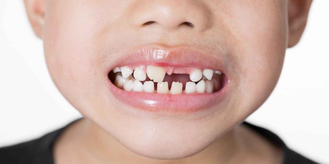 Teeth Crowding: Causes, Signs, and Best Treatment Options at Smiline Clinic