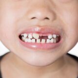 Teeth Crowding: Causes, Signs, and Best Treatment Options at Smiline Clinic
