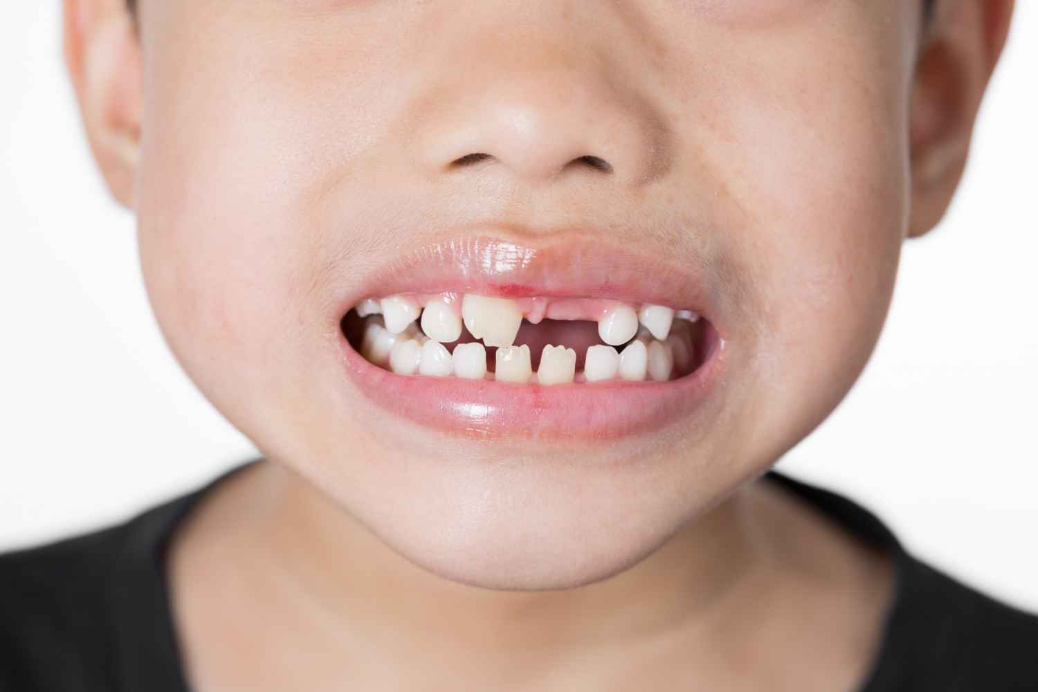 Teeth Crowding: Causes, Signs, and Best Treatment Options at Smiline Clinic Teeth Crowding: Causes, Signs, and Best Treatment Options at Smiline Clinic