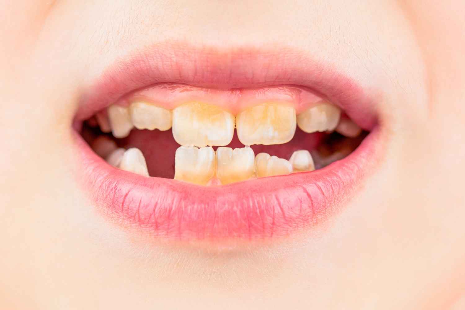 Teeth Crowding: Causes, Signs, and Best Treatment Options at Smiline Clinic Teeth Crowding: Causes, Signs, and Best Treatment Options at Smiline Clinic