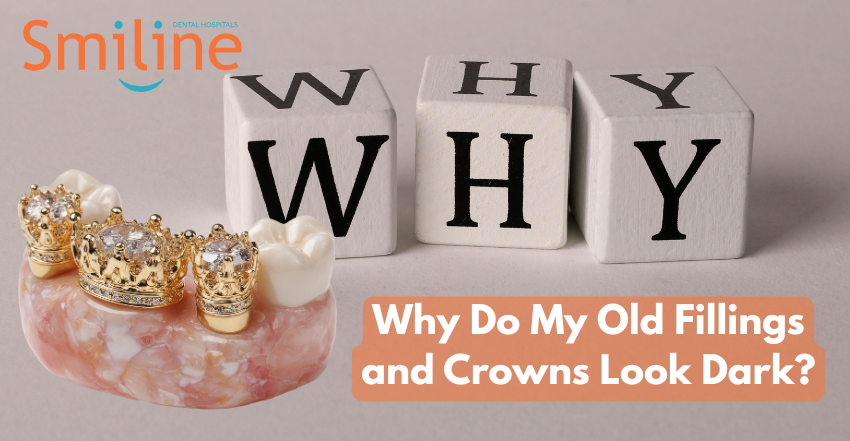 Why Do My Old Fillings and Crowns Look Dark Why Do My Old Fillings and Crowns Look Dark?