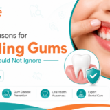 10 reason for bleeding gum you should know