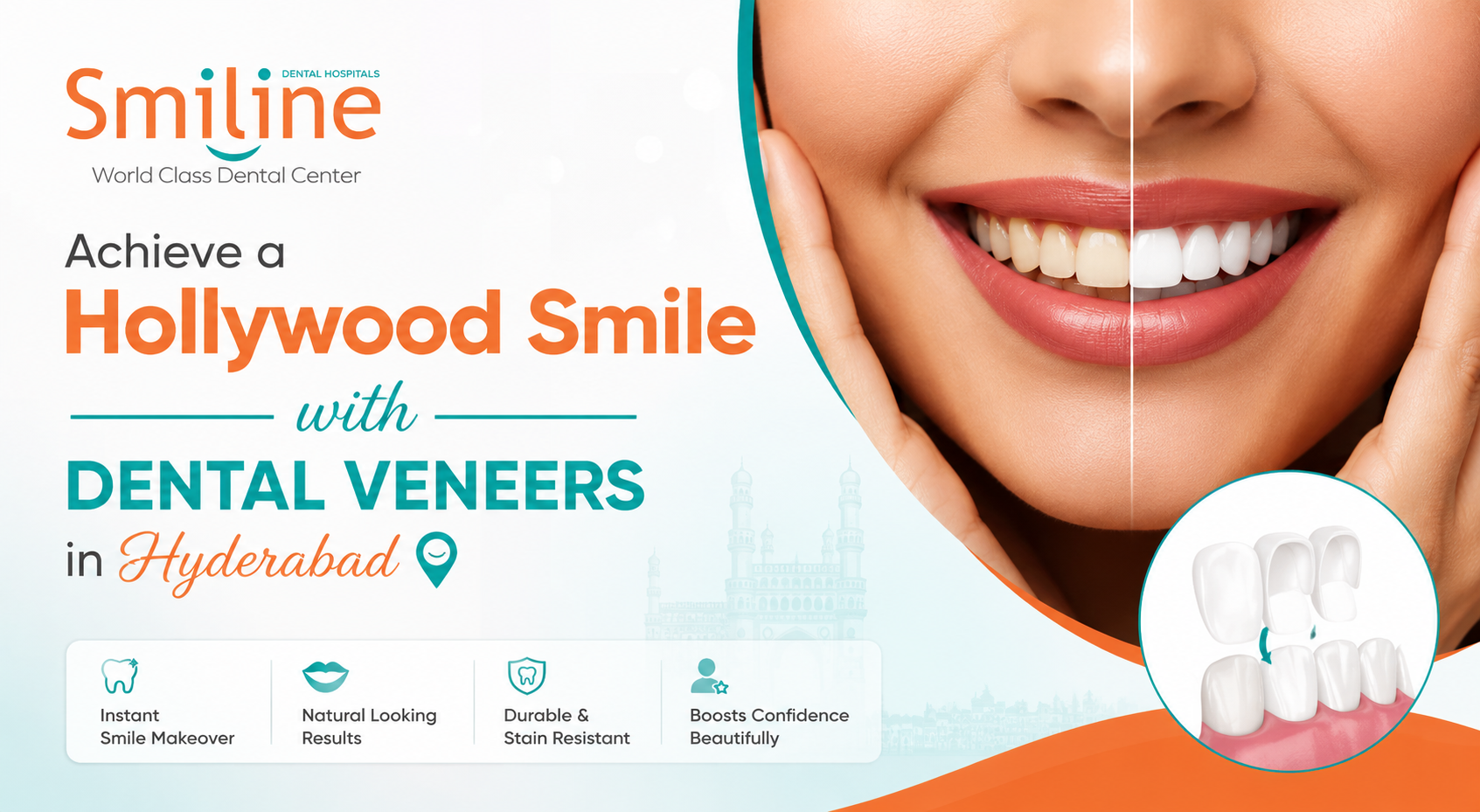 Smiline blog banner 5 Patient showcasing a smile makeover with dental veneers in Hyderabad, highlighting natural-looking, stain-resistant veneers for a confident Hollywood smile at Smiline Dental Hospitals.